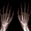 upload/articles/thumbs/160712094210Rheumatoid arthritis of the wrist & hand.jpg